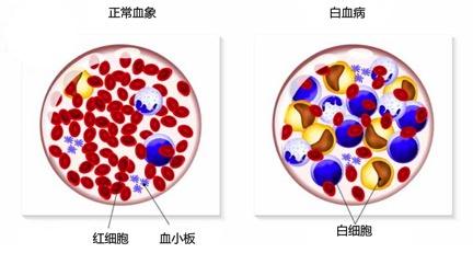 甲醛檢測(cè)機(jī)構(gòu)告訴你甲醛與白血病之間有著怎樣的聯(lián)系